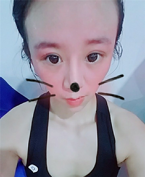 给姐妹们看看我的鼻部手术案例啦,我的鼻子恢复的很好,大家可不要羡慕我哦,哈哈哈哈,下面给大家看看我的隆鼻经历!哇咔咔,嘿嘿~~~~