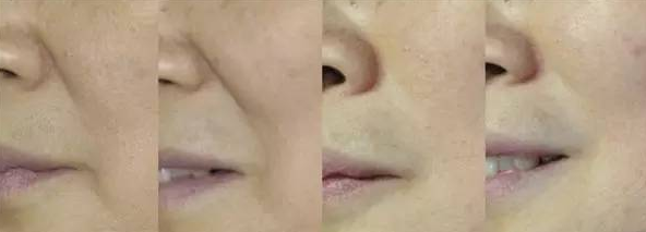 鼻唇沟,法令纹的形成原因和调节策略