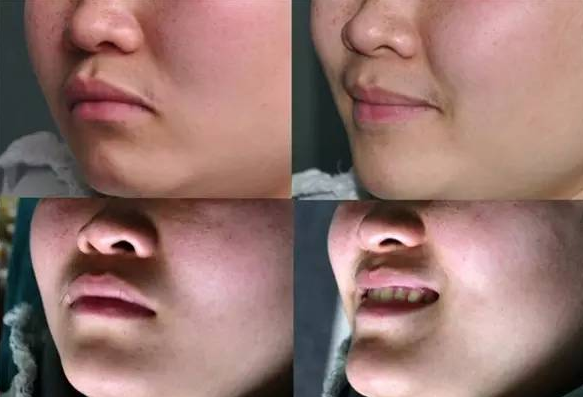 鼻唇沟,法令纹的形成原因和调节策略