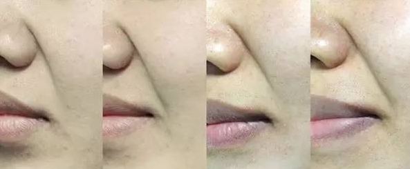 鼻唇沟,法令纹的形成原因和调节策略