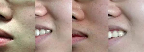 鼻唇沟,法令纹的形成原因和调节策略