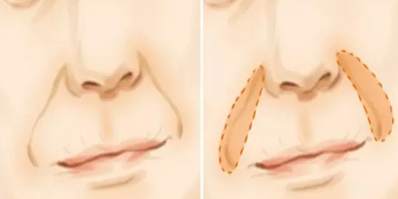 鼻唇沟,法令纹的形成原因和调节策略