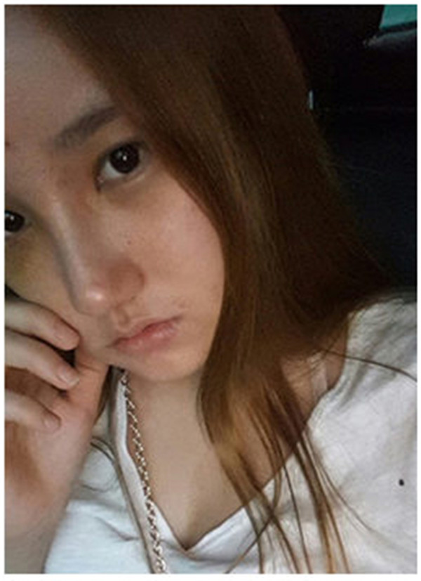 宝宝们,我来给你们分享我的隆鼻案例啦~~~2018年祝大家新年快乐,一路发!