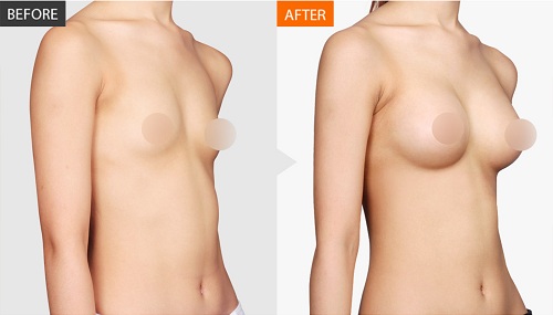 隆胸后你担心的这些问题了解一下