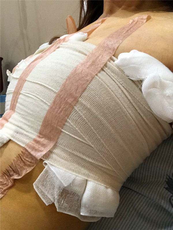 哈尔滨索菲陈富全假体隆胸