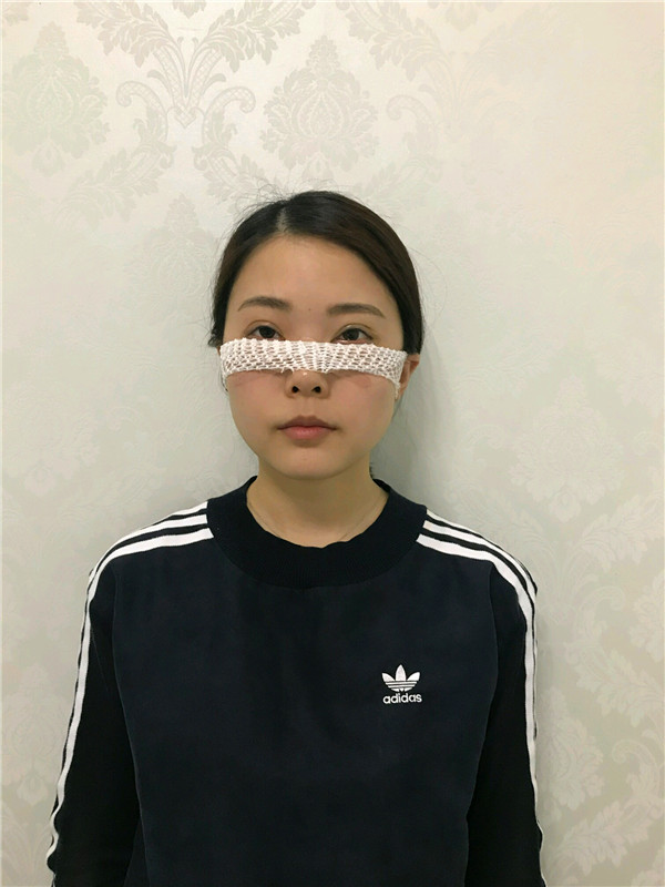 杭州艺星雷中元内切去眼袋