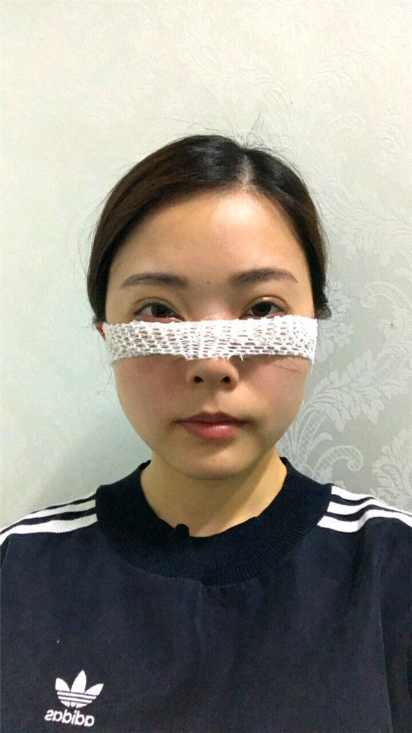 杭州艺星雷中元内切去眼袋