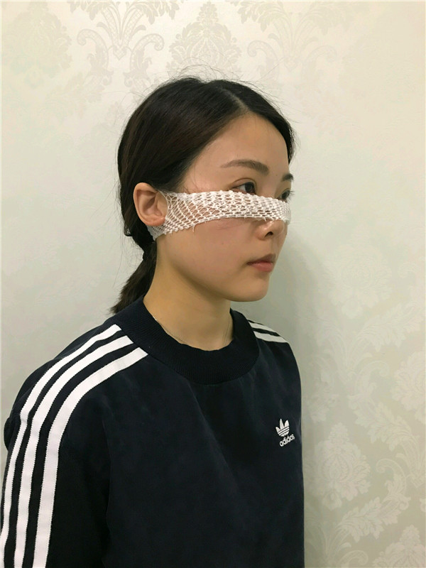 杭州艺星雷中元内切去眼袋