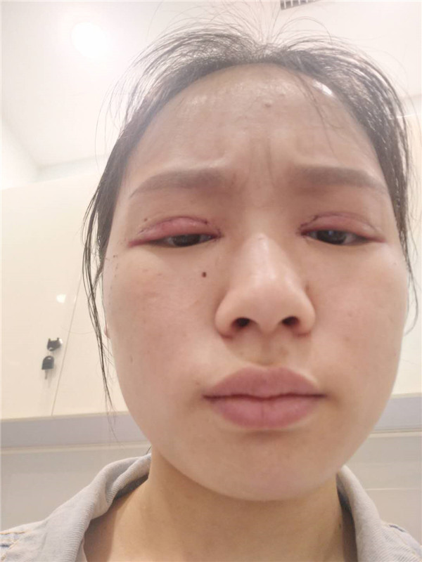 重庆红颜拜博黄力割双眼皮