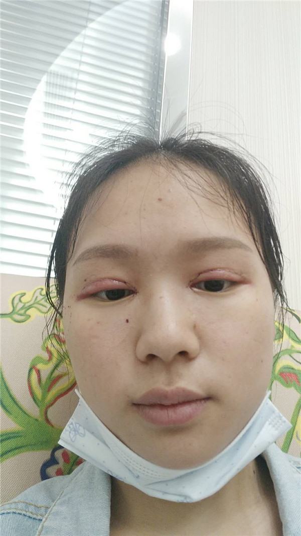 重庆红颜拜博黄力割双眼皮