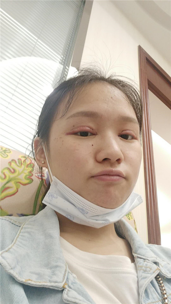重庆红颜拜博黄力割双眼皮