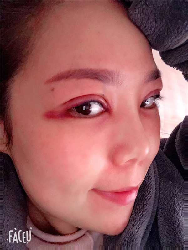 上海翡立思割双眼皮案例