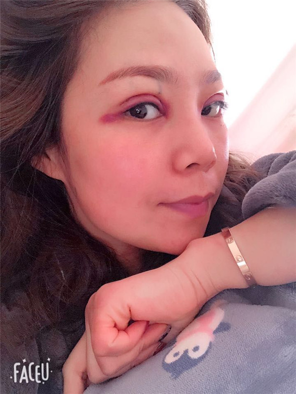 上海翡立思割双眼皮案例