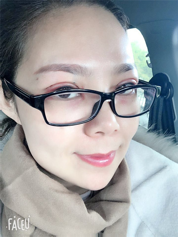 上海翡立思割双眼皮案例