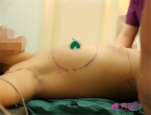 成都艺星隆胸案例分享,艺星隆胸怎么样?价格多少钱?