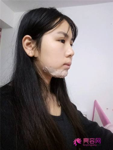 南宁农霖自体脂肪垫下巴