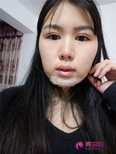 南宁农霖自体脂肪垫下巴