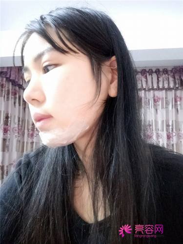 南宁农霖自体脂肪垫下巴