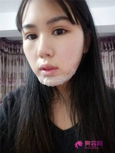 南宁农霖自体脂肪垫下巴