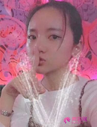 天津菲丝澜郭锋膨体隆鼻案例
