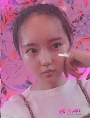 天津菲丝澜郭锋膨体隆鼻案例