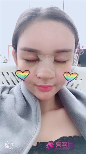 广州懿美秀罗辉耳软骨隆鼻