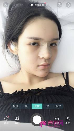 广州懿美秀罗辉耳软骨隆鼻
