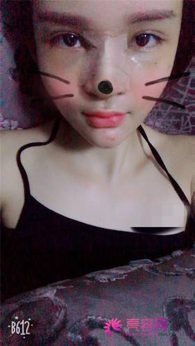 广州懿美秀罗辉耳软骨隆鼻
