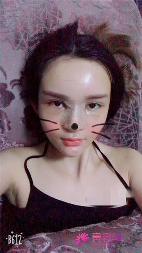 广州懿美秀罗辉耳软骨隆鼻