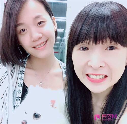 北京丽星魏志香双眼皮