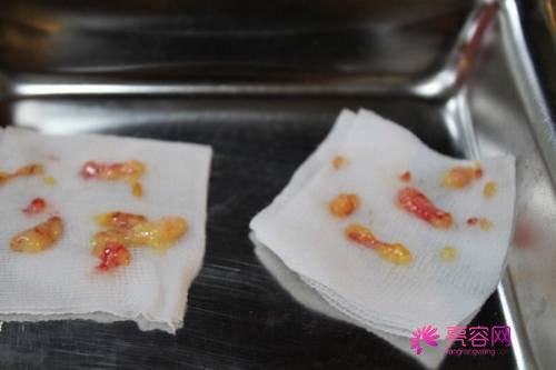 北京丽星魏志香双眼皮