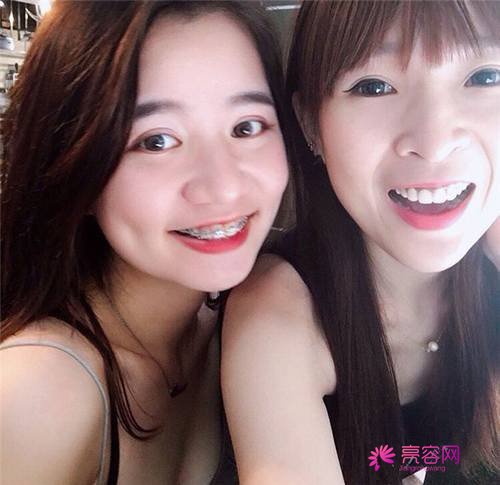 北京丽星魏志香双眼皮