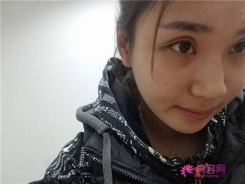 北京炫美徐学东自体脂肪填充