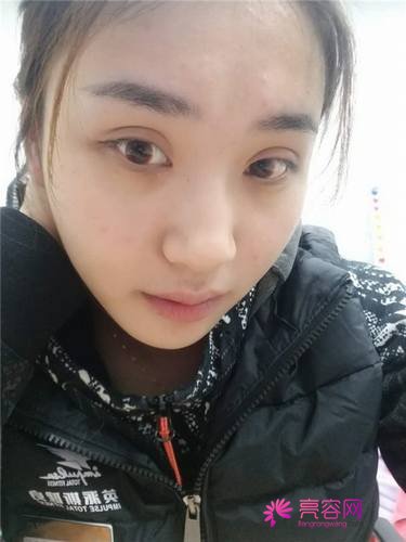 北京炫美徐学东自体脂肪填充