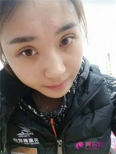 北京炫美徐学东自体脂肪填充