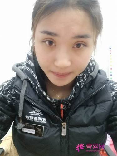 北京炫美徐学东自体脂肪填充