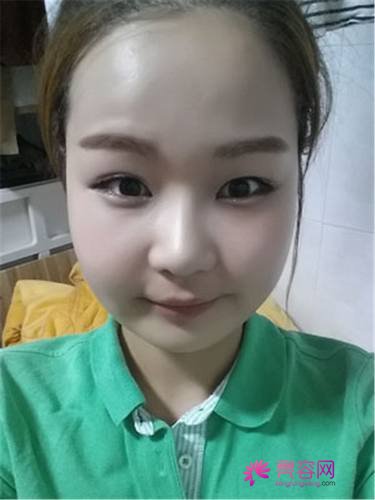 北京爱多邦王绍国自体脂肪填充