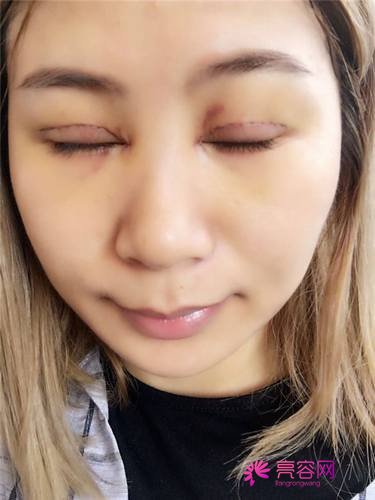 上海百达丽邵玉芳双眼皮