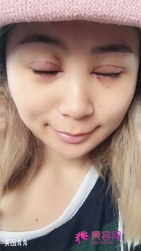 上海百达丽邵玉芳双眼皮