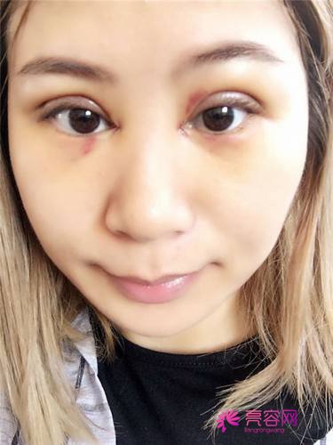 上海百达丽邵玉芳双眼皮