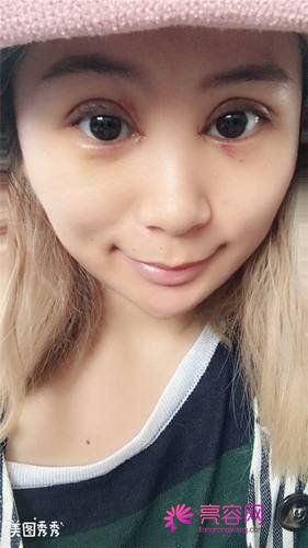 上海百达丽邵玉芳双眼皮