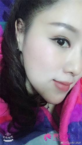 北京来美安王振军双眼皮内眼角