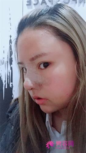 上海天大刘先超隆鼻