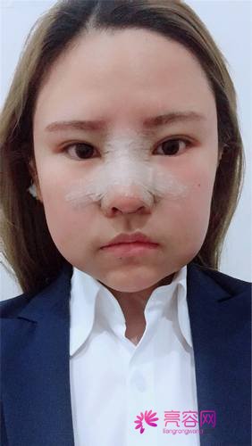上海天大刘先超隆鼻