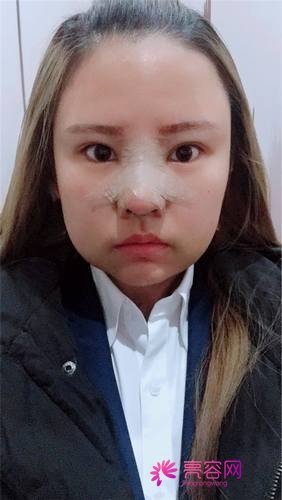 上海天大刘先超隆鼻
