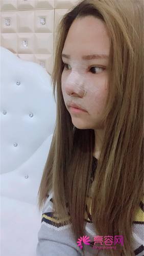上海天大刘先超隆鼻
