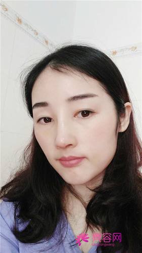 长沙美莱周文亮隆鼻