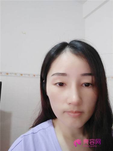 长沙美莱周文亮隆鼻