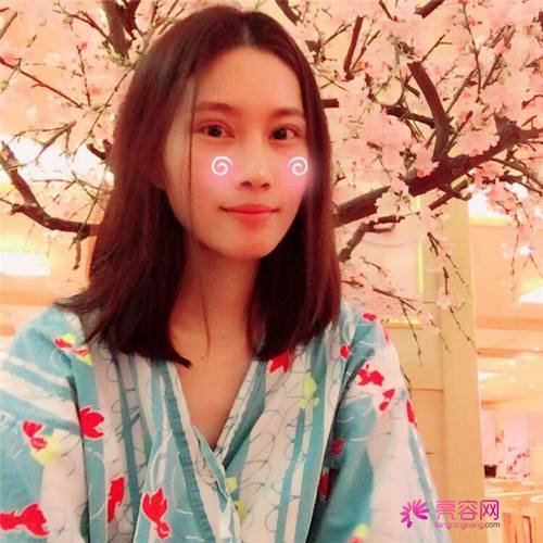 北京亚馨美莱坞张海明双眼皮