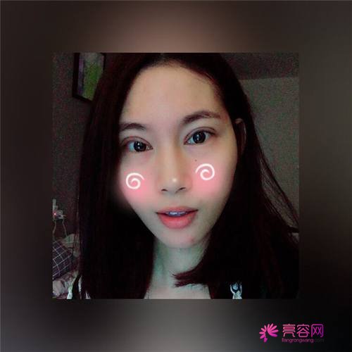 北京亚馨美莱坞张海明双眼皮